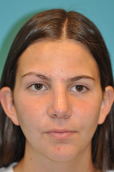 Rhinoplasty (Nose Job) Before and After Photos Case 5290 After Photo Rhinoplasty (Nose Job) Before and After Photos
