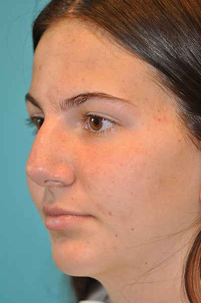 Rhinoplasty (Nose Job) Before and After Photos Case 5290 Before Photo Rhinoplasty (Nose Job) Before and After Photos