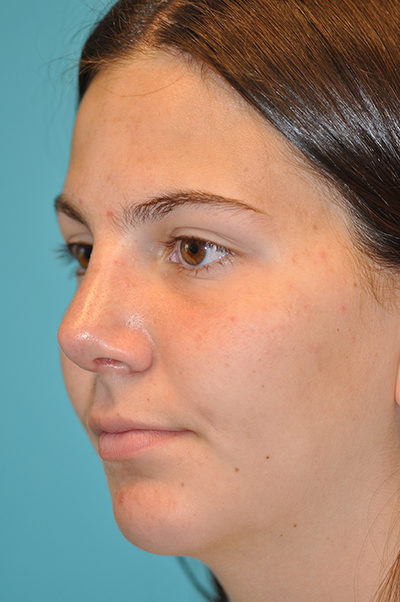 Rhinoplasty (Nose Job) Before and After Photos Case 5290 After Photo Rhinoplasty (Nose Job) Before and After Photos