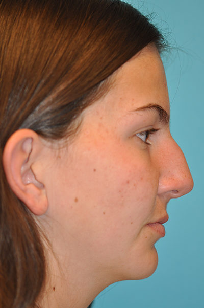 Rhinoplasty (Nose Job) Before and After Photos Case 5290 Before Photo Rhinoplasty (Nose Job) Before and After Photos
