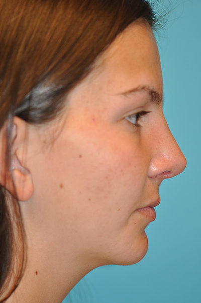 Rhinoplasty (Nose Job) Before and After Photos Case 5290 After Photo Rhinoplasty (Nose Job) Before and After Photos
