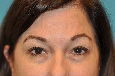 Upper Blepharoplasty (Eyelid)