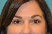 Upper Blepharoplasty (Eyelid) Before and After Photos