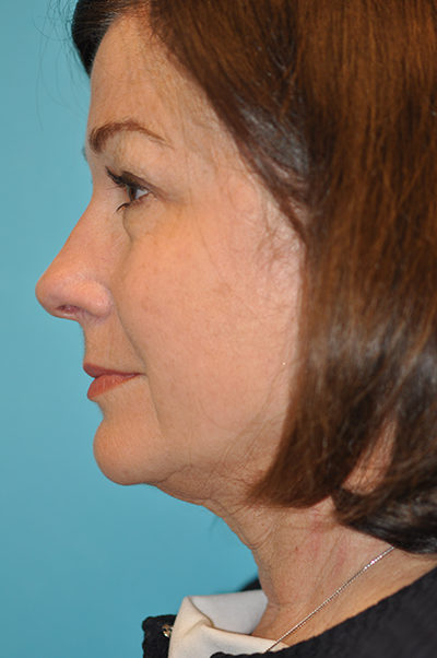 Upper Blepharoplasty (Eyelid)