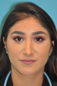 Rhinoplasty (Nose Job) Before and After Photos