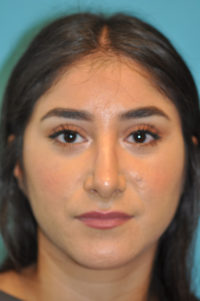 Rhinoplasty (Nose Job) Before and After Photos