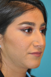 Rhinoplasty (Nose Job) Before and After Photos
