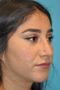 Rhinoplasty (Nose Job) Before and After Photos