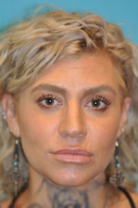 Rhinoplasty (Nose Job) Before and After Photos