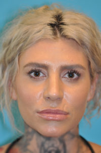 Rhinoplasty (Nose Job) Before and After Photos