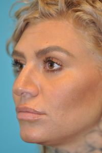 Rhinoplasty (Nose Job) Before and After Photos