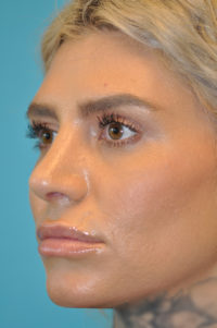 Rhinoplasty (Nose Job) Before and After Photos