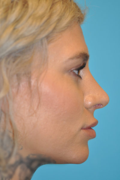 Rhinoplasty (Nose Job) Before and After Photos Case 5308 After Photo Rhinoplasty (Nose Job) Before and After Photos
