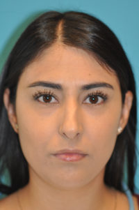 Rhinoplasty (Nose Job) Before and After Photos