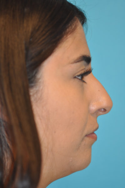 Rhinoplasty (Nose Job) Before and After Photos