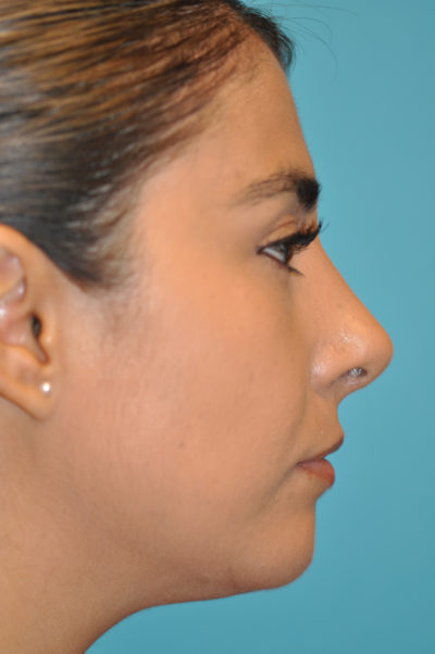 Rhinoplasty (Nose Job) Before and After Photos