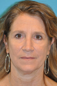 Lower Blepharoplasty (Eyelid) Before and After Photos