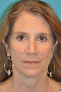 Lower Blepharoplasty (Eyelid) Before and After Photos