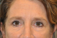 Lower Blepharoplasty (Eyelid) Before and After Photos