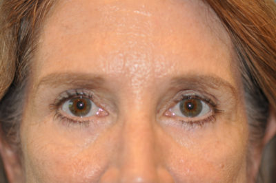 Lower Blepharoplasty (Eyelid) Before and After Photos Case 5330 After Photo Lower Blepharoplasty (Eyelid) Before and After Photos