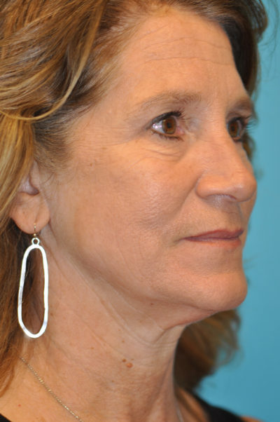 Lower Blepharoplasty (Eyelid) Before and After Photos Case 5330 Before Photo Lower Blepharoplasty (Eyelid) Before and After Photos