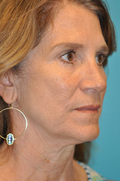 Lower Blepharoplasty (Eyelid)