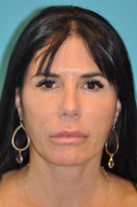 Facelift and Necklift Before and After Photos