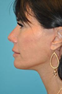 Facelift and Necklift Before and After Photos