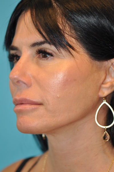 Rhytidectomy (Facelift) Before and After Photos