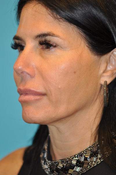 Rhytidectomy (Facelift) Before and After Photos