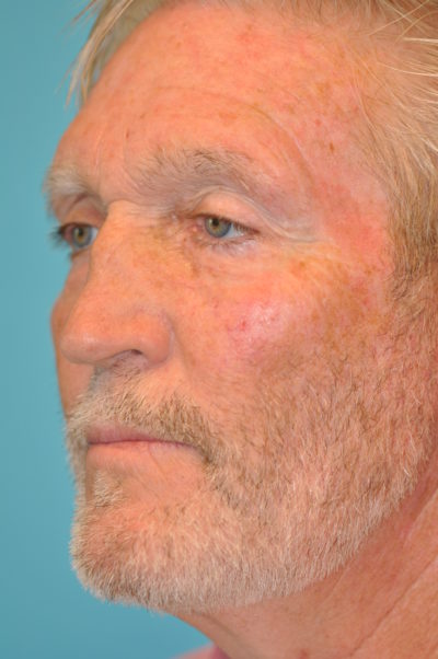Revision Rhinoplasty Before and After Photos Case Patient 11 Before Photo Revision Rhinoplasty Before and After Photos