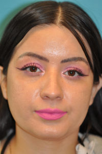 Rhinoplasty (Nose Job) Before and After Photos