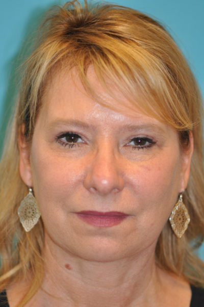 Upper Blepharoplasty (Eyelid) Before and After Photos Case 5394 After Photo Upper Blepharoplasty (Eyelid) Before and After Photos