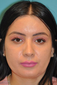 Rhinoplasty (Nose Job) Before and After Photos