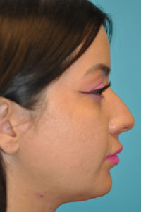 Rhinoplasty (Nose Job) Before and After Photos