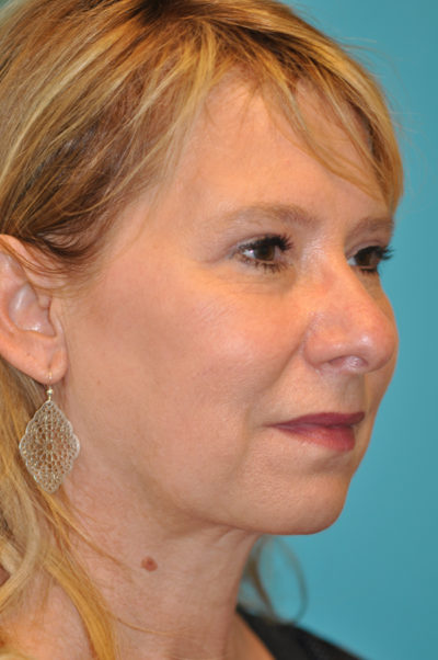 Upper Blepharoplasty (Eyelid) Before and After Photos Case 5394 After Photo Upper Blepharoplasty (Eyelid) Before and After Photos