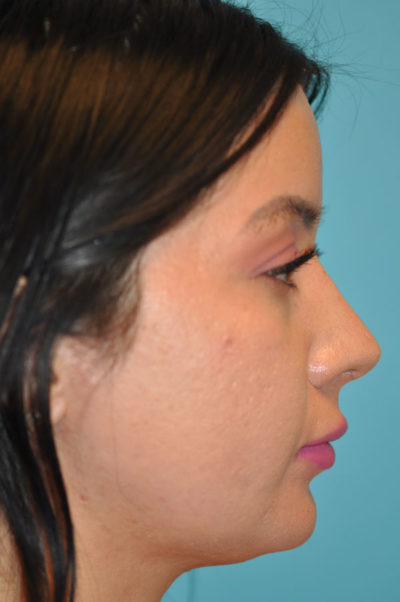 Rhinoplasty (Nose Job) Before and After Photos Case 5387 After Photo Rhinoplasty (Nose Job) Before and After Photos