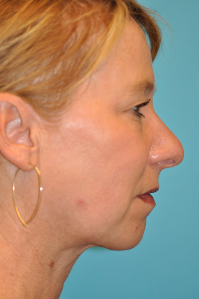 Upper Blepharoplasty (Eyelid)