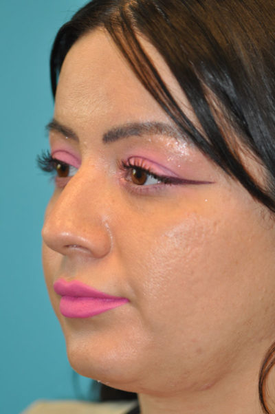 Rhinoplasty (Nose Job) Before and After Photos Case 5387 Before Photo Rhinoplasty (Nose Job) Before and After Photos