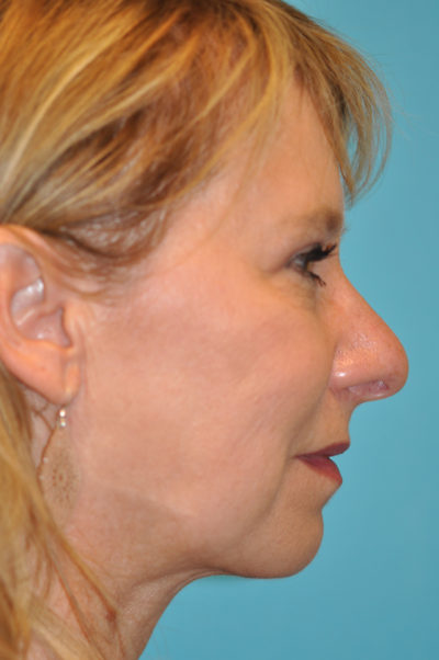 Upper Blepharoplasty (Eyelid)