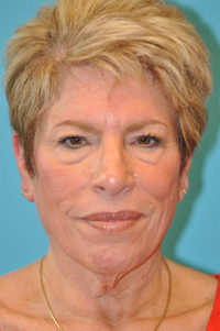 Upper Blepharoplasty (Eyelid) Before and After Photos