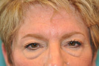 Upper Blepharoplasty (Eyelid) Before and After Photos