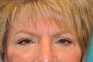 Upper Blepharoplasty (Eyelid) Case 5370 After Photo Upper Blepharoplasty (Eyelid)