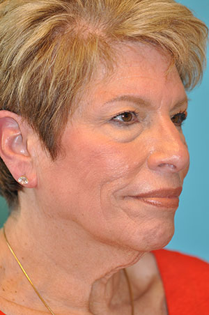 Upper Blepharoplasty (Eyelid) Case 5370 Before Photo Upper Blepharoplasty (Eyelid)