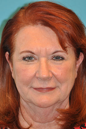 Upper Blepharoplasty (Eyelid) Before and After Photos Case 5377 After Photo Upper Blepharoplasty (Eyelid) Before and After Photos