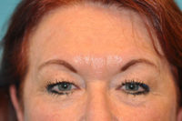 Upper Blepharoplasty (Eyelid) Before and After Photos