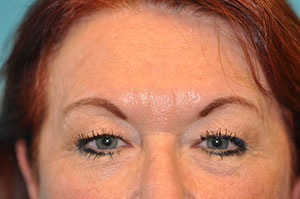 Upper Blepharoplasty (Eyelid) Before and After Photos Case 5377 Before Photo Upper Blepharoplasty (Eyelid) Before and After Photos