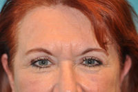 Upper Blepharoplasty (Eyelid) Before and After Photos