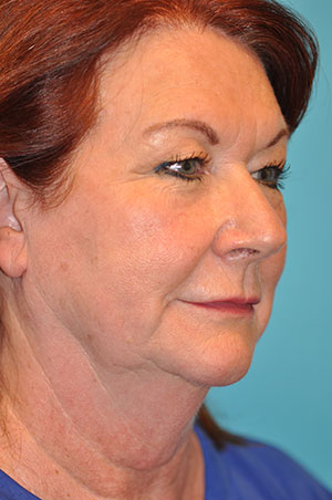Upper Blepharoplasty (Eyelid) Before and After Photos Case 5377 Before Photo Upper Blepharoplasty (Eyelid) Before and After Photos