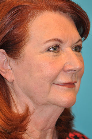 Upper Blepharoplasty (Eyelid) Before and After Photos Case 5377 After Photo Upper Blepharoplasty (Eyelid) Before and After Photos